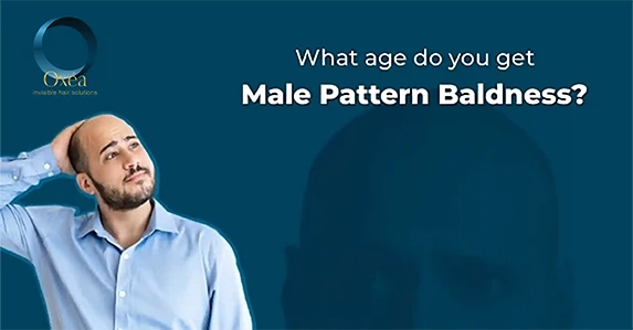 What Age Do You Get Male Pattern Baldness?