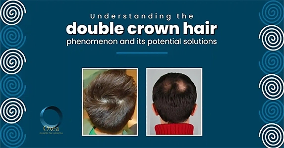 Understanding the double crown hair phenomenon and its potential solutions