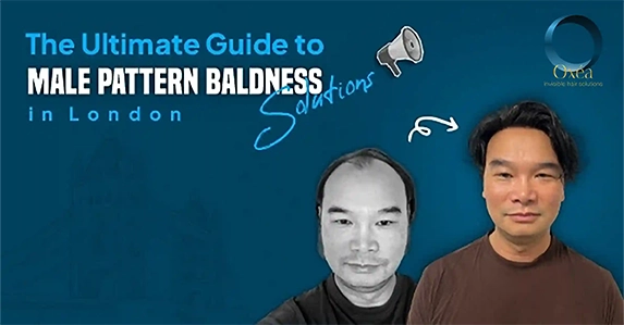 The Ultimate Guide to Male Pattern Baldness Solutions in London