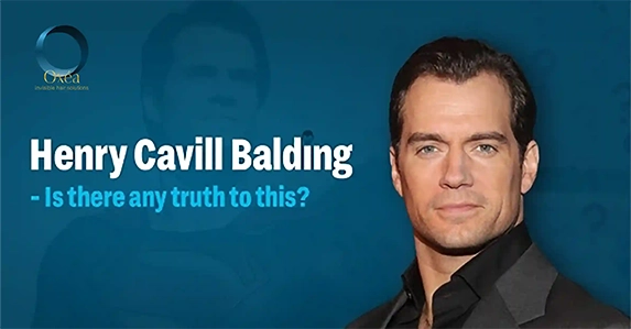 henry cavill balding 2424