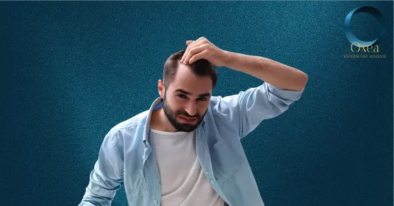 Temple Hair Loss